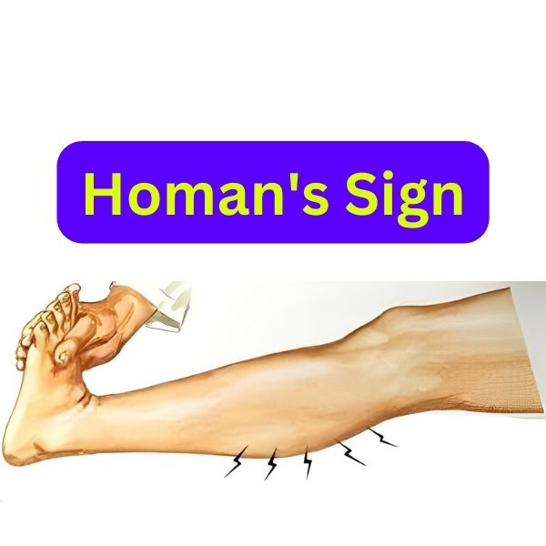 Homan's Sign: A Test for Diagnosing Deep Vein Thrombosis (DVT) - The ...