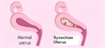 What is Synechiae Uterus and How to Treat It in 2023?