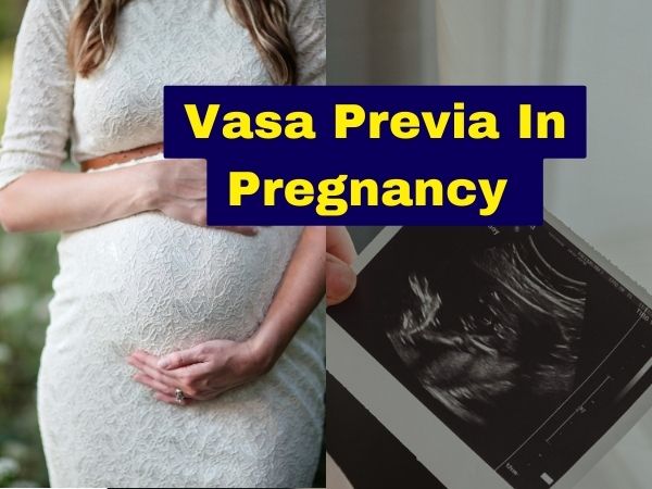Vasa Previa: Causes. Symptoms, Management & Treatment